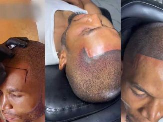 "What if he goes b@ld in old age?" – Man takes drast!c measure to define hairline, gets permanent tattoo (VIDEO)