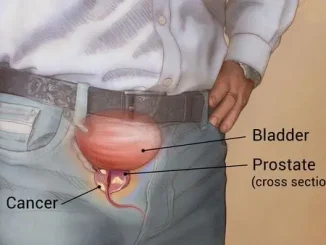 Prostate Cancer: The Silent Killer Nigerian Men Must Not Ignore – Expert Insights