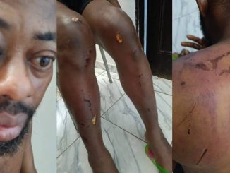 Photos show injuries sustained by NANS president after alleged attack by Seyi Tinubu’s thugs